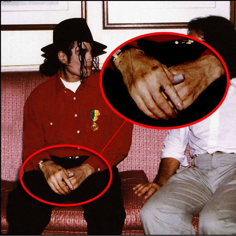 MJ-s-vitiligo-michael-jackson-11957264-768-768