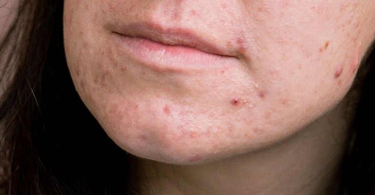 causas-acne-rostro-menton