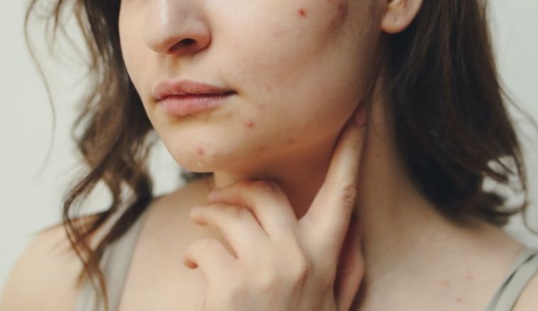 causas-acne-rostro